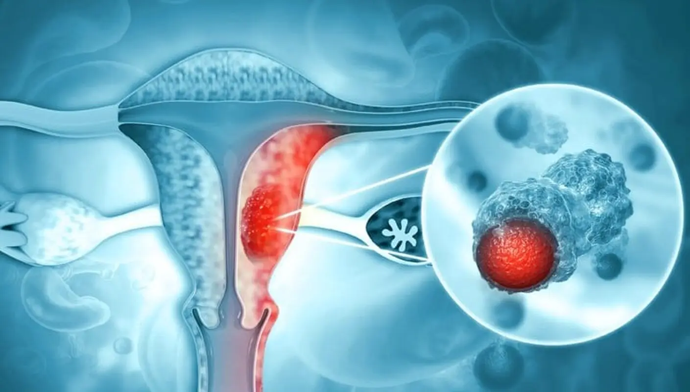 سرطان رحم و hpv