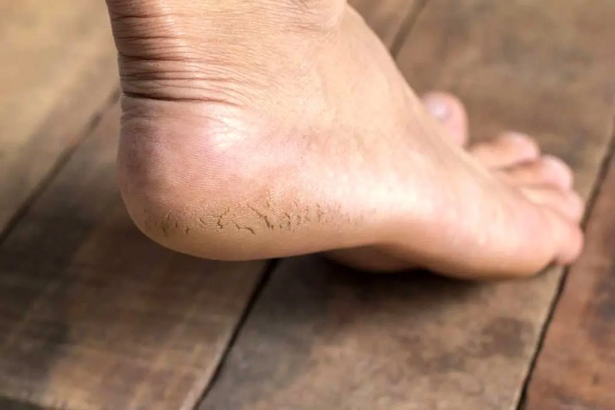 راز داشتن پاهایی نرم و سالم: روشهای طلایی برای درمان و پیشگیری از ترک پا