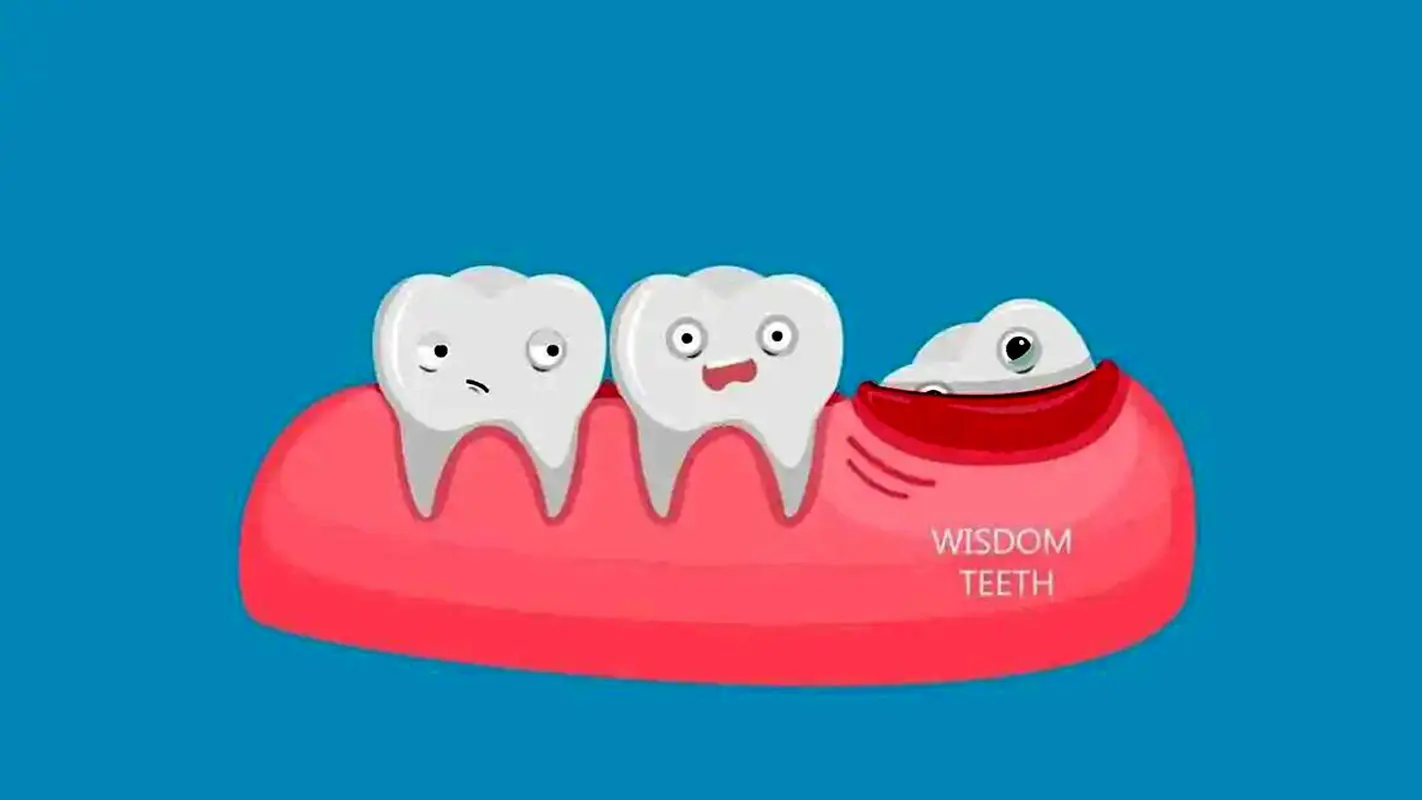 دندان عقل نیمه نهفته چه عوارضی دارد؟