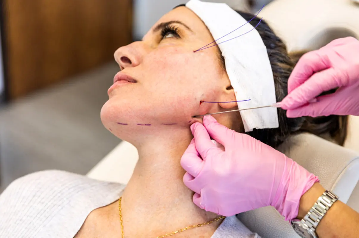 خارج سازی نخهای لیفت عفونت کرده چگونه انجام میشود؟
