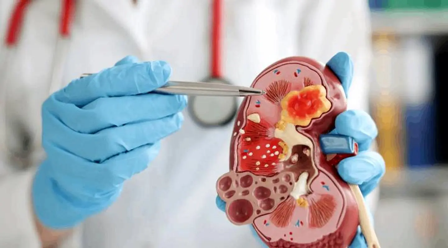 همه اطلاعات درباره سنگ کلیه و درمانش
