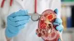 همه اطلاعات درباره سنگ کلیه و درمانش