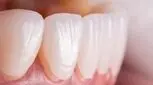 لمینت دندان اقساطی (شرایط را بخوانید)  
