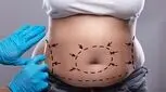 اندولیفت شکم، برداشتن چربی و لیفت پوست بدون جراحی