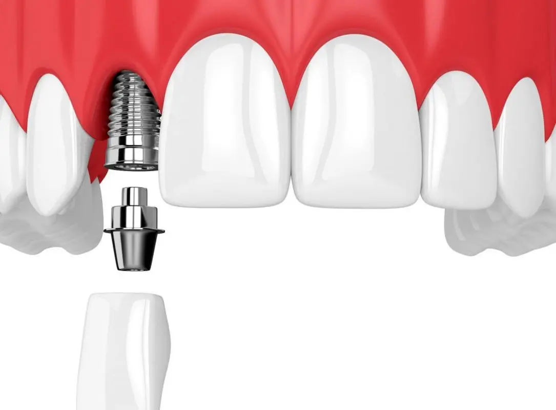 تفاوت بریج با ایمپلنت چیست؟