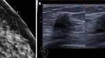  آیا سرطان سینه با سونوگرافی قابل مشاهده است؟