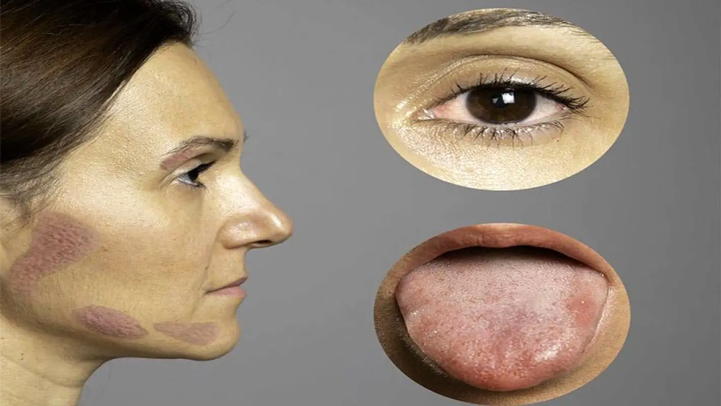 سندروم شوگرن یک بیماری ناشناخته اما شایع در میان زنان