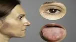 سندروم شوگرن یک بیماری ناشناخته اما شایع در میان زنان 

