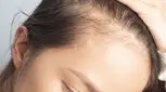 کاشت مو به روش fut، برای رفع طاسی سر