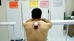 هشدار وزارت بهداشت/ حجامت راه درمان قطعی نیست
