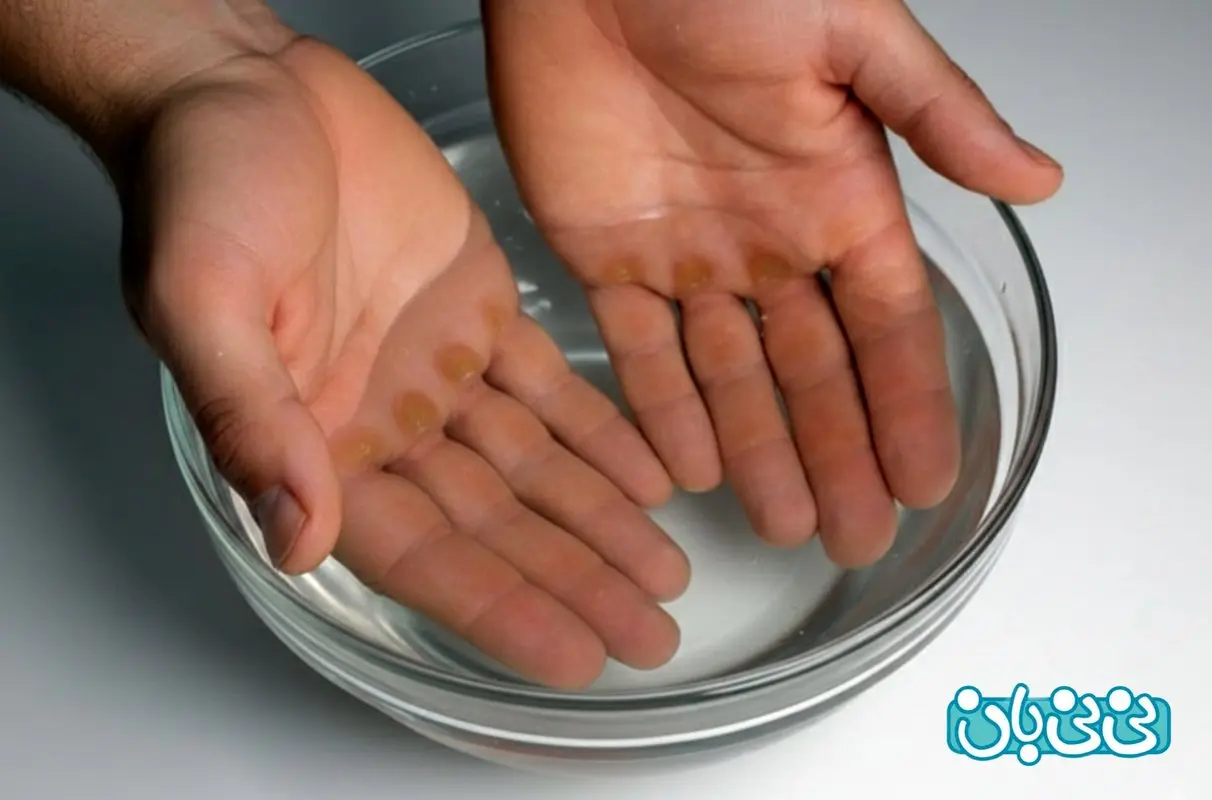 درمان میخچه دست _ علت ها، 6 روش‌ خانگی و درمان‌های پزشکی