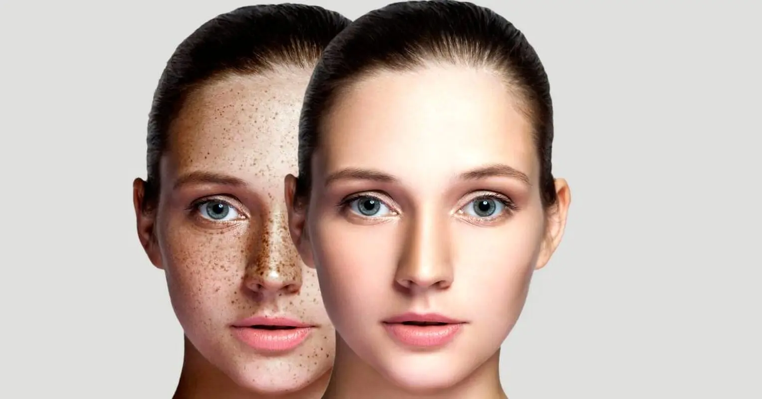 چرا پوست صورت خانم‌ها بدرنگ می‌شود؟/ معرفی چند درمان خانگی