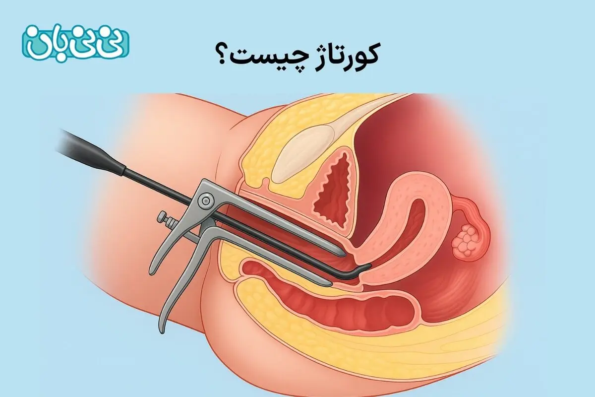 کورتاژ چیست؟ از روش انجام تا ۲ دلیل شایع + عوارض و نکات مراقبتی بعد از آن