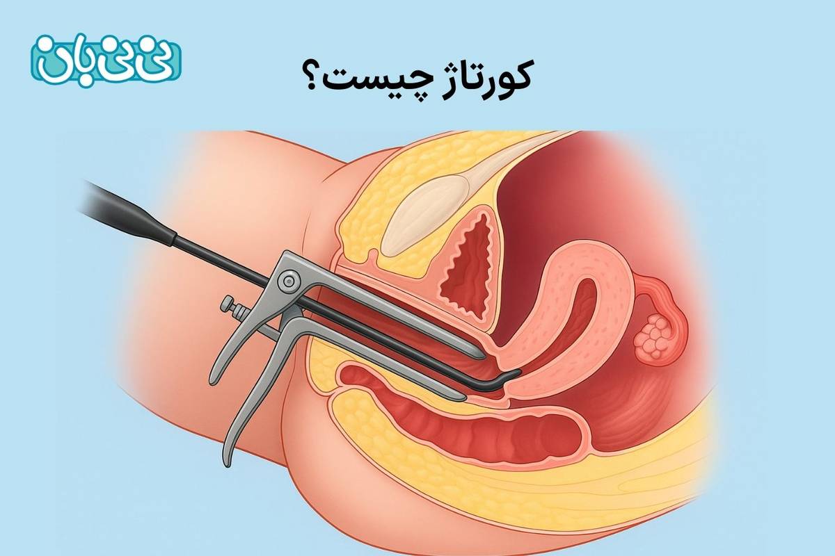 کورتاژ چیست؟ از روش انجام تا ۲ دلیل شایع + عوارض و نکات مراقبتی بعد از آن