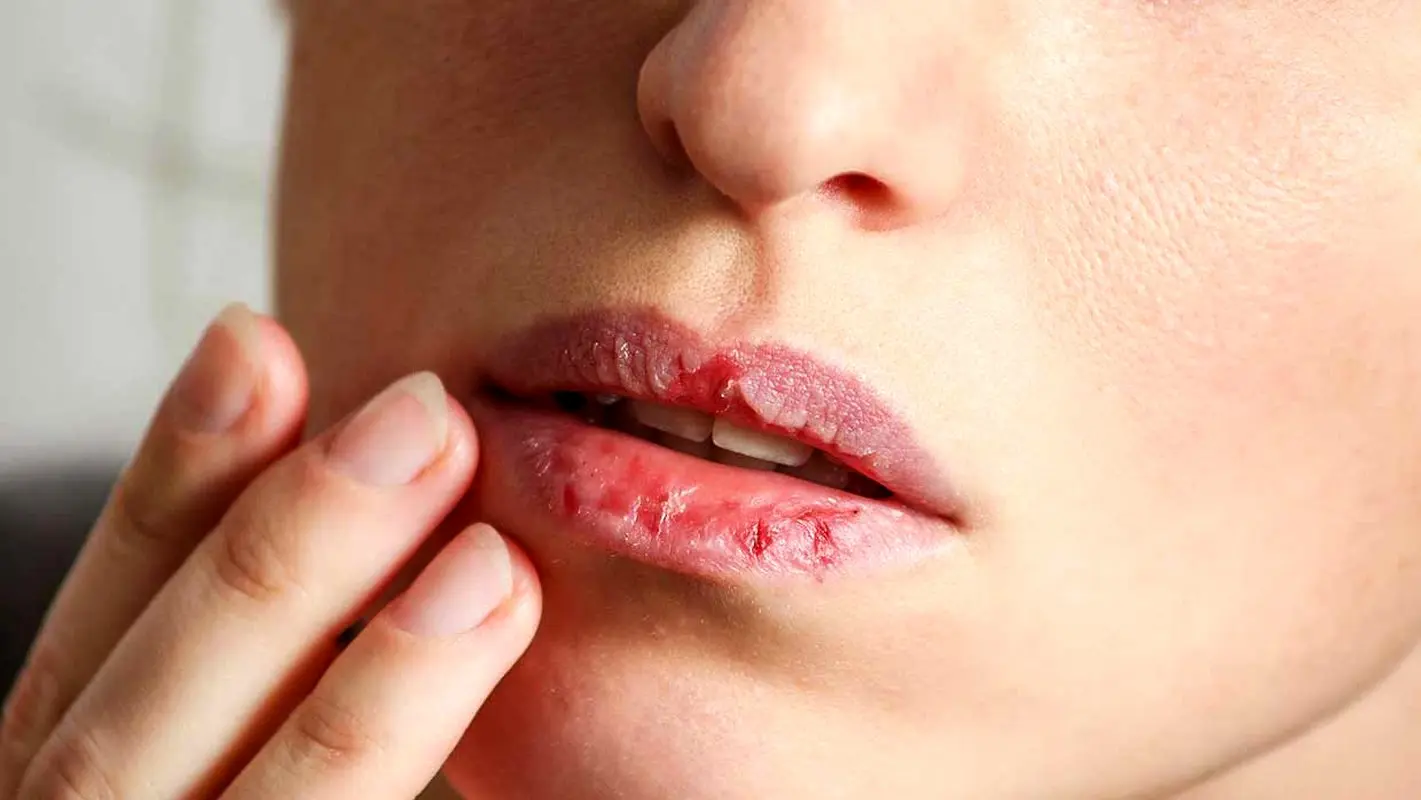 درمان ترک لب در خانه 