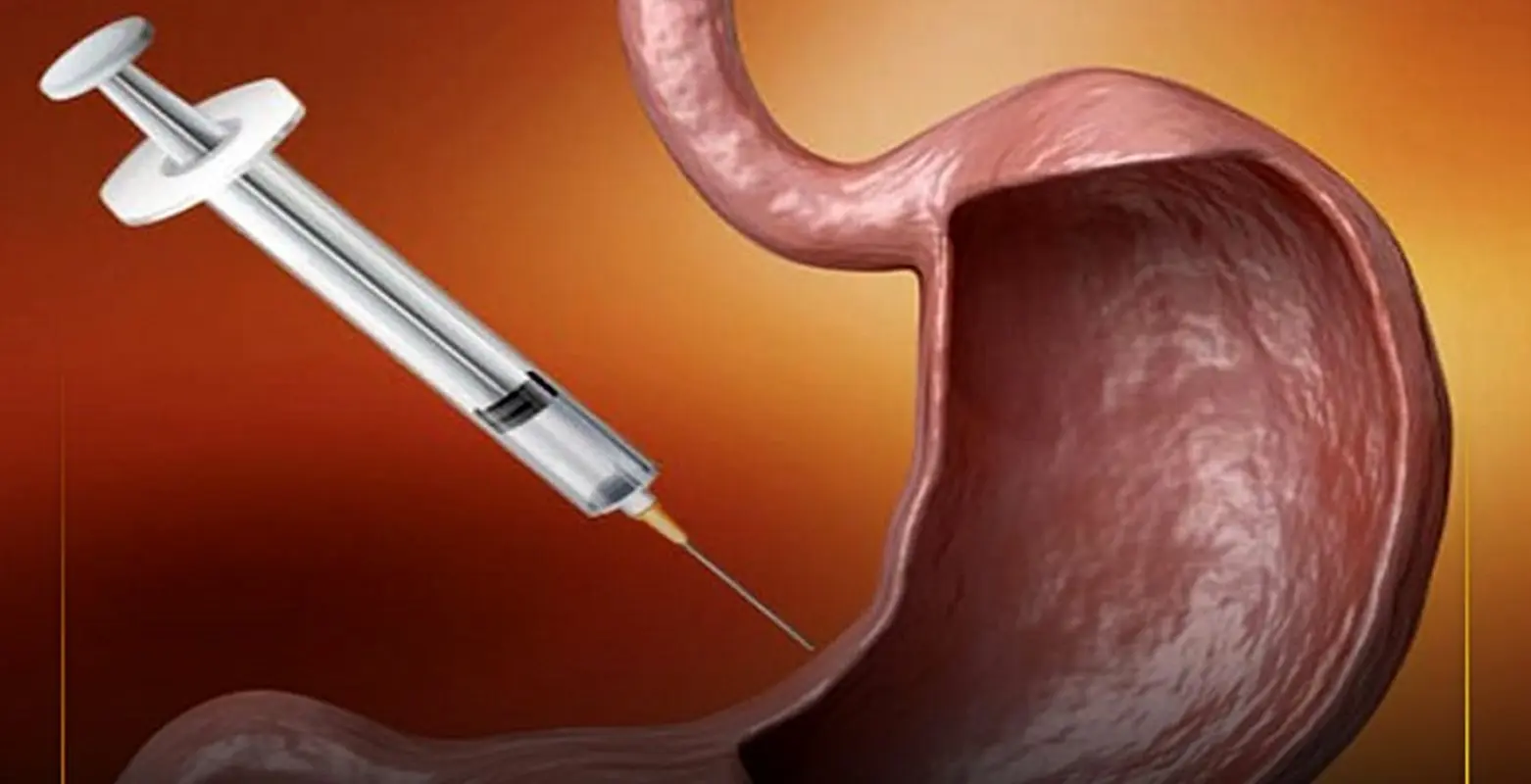 بوتاکس معده چیست؟ راهی برای لاغری