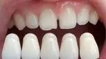 لمینت دندان بدون تراش چه مزایا و معایبی دارد؟

