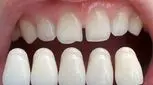 لمینت دندان بدون تراش چه مزایا و معایبی دارد؟
