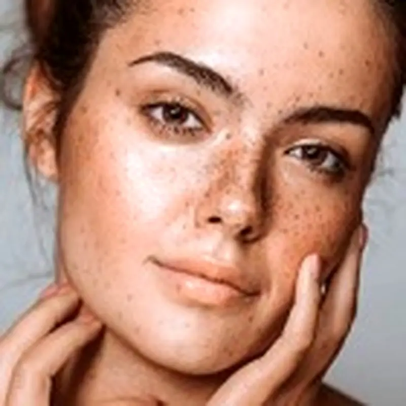 علت لک پوستی در خانم های جوان و میانسال: روش های درمانی