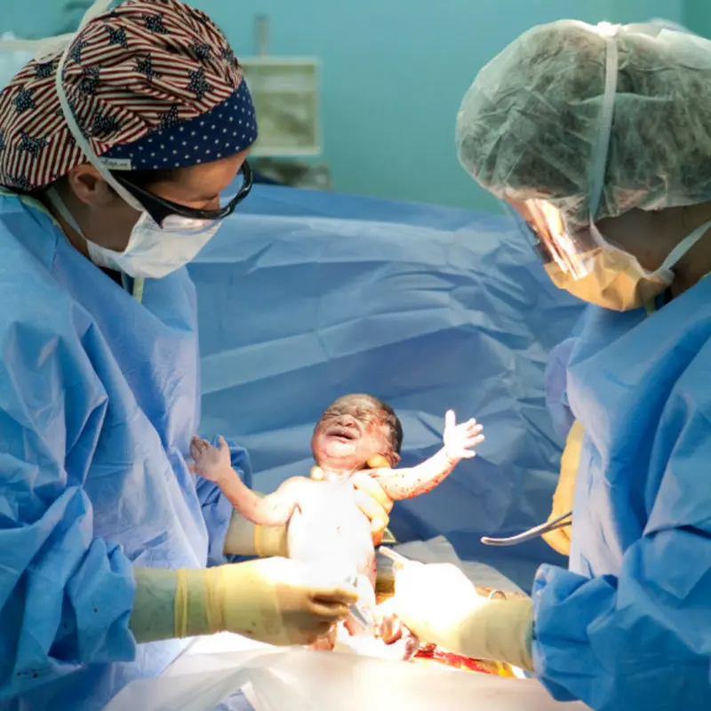 زایمان سزارین و هرچه باید درباره آن بدانید