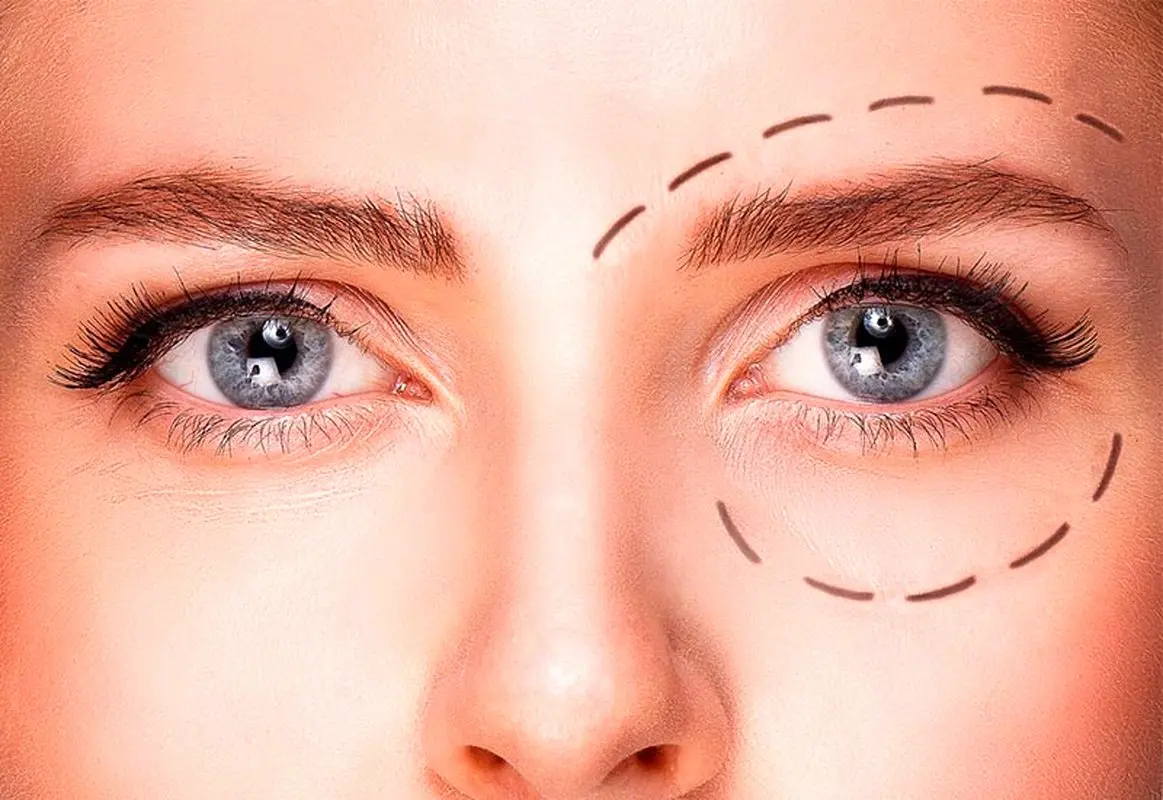 درمان افتادگی پلک با لیزر + مزایا معایب و هزینه آن