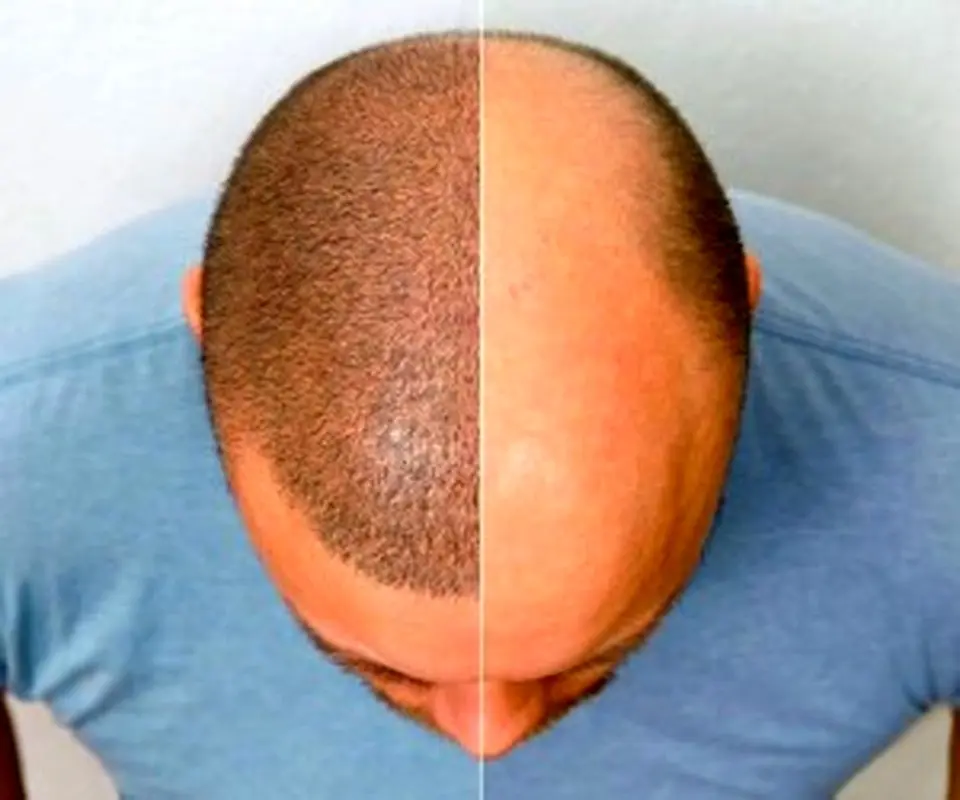 هزینه کاشت مو به روش DHI چقدر است؟