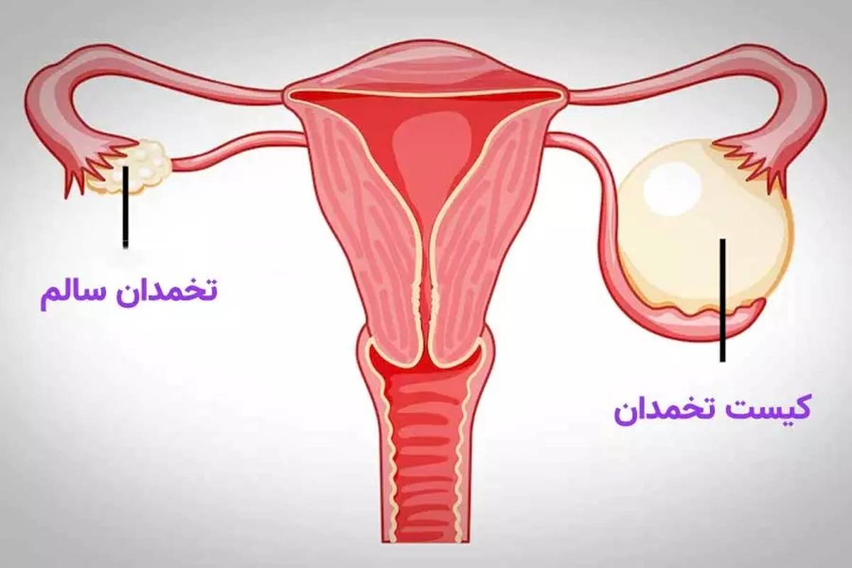 درمان تنبلی تخمدان با رازیانه، موثر است؟