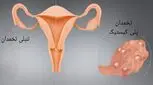 3 تفاوت تنبلی تخمدان با تخمدان پلی‌کیستیک - در علت، علائم و درمان