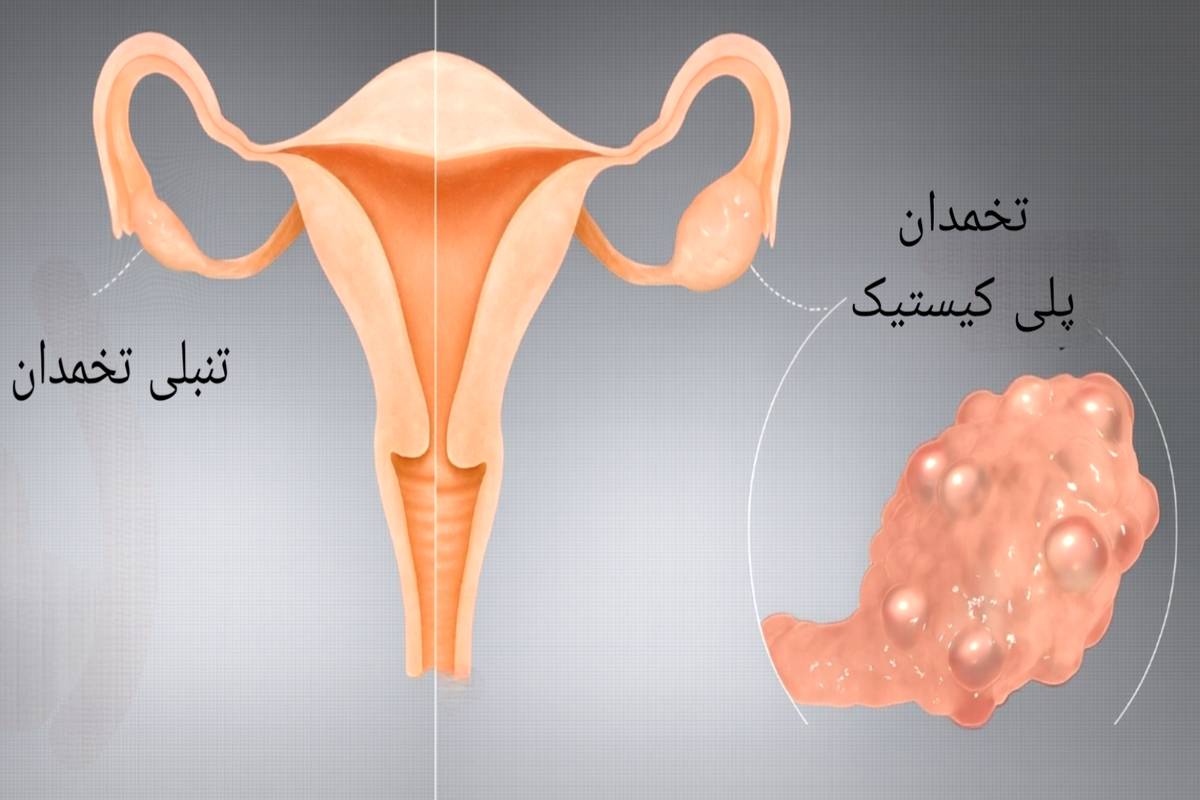 تفاوت تنبلی تخمدان با تخمدان پلیکیستیک | بررسی علل تا روشهای درمان