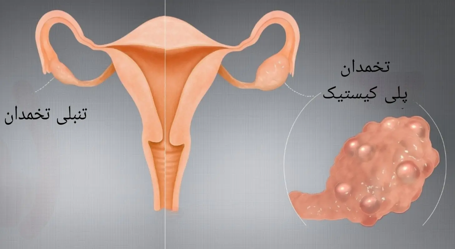 3 تفاوت تنبلی تخمدان با تخمدان پلی‌کیستیک - در علت، علائم و درمان