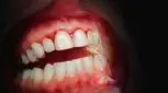 تحلیل لثه در بارداری، علل و راه های درمان