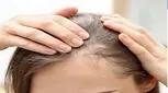 عادت‌های رایجی که ریزش مو را در زنان تسریع می‌کنند