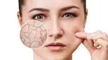 مقابله چند مرحله ای با این عارضه ناراحت کننده پوستی