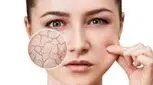مقابله چند مرحله ای با این عارضه ناراحت کننده پوستی