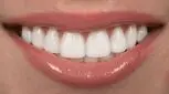 با لکه های قهوه ای روی دندان هایم چه کنم؟ 
