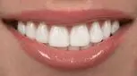 با لکه های قهوه ای روی دندان هایم چه کنم؟ 