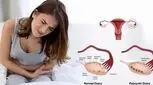 تنبلی تخمدان درمان نشود باعث ناباروری می‌شود