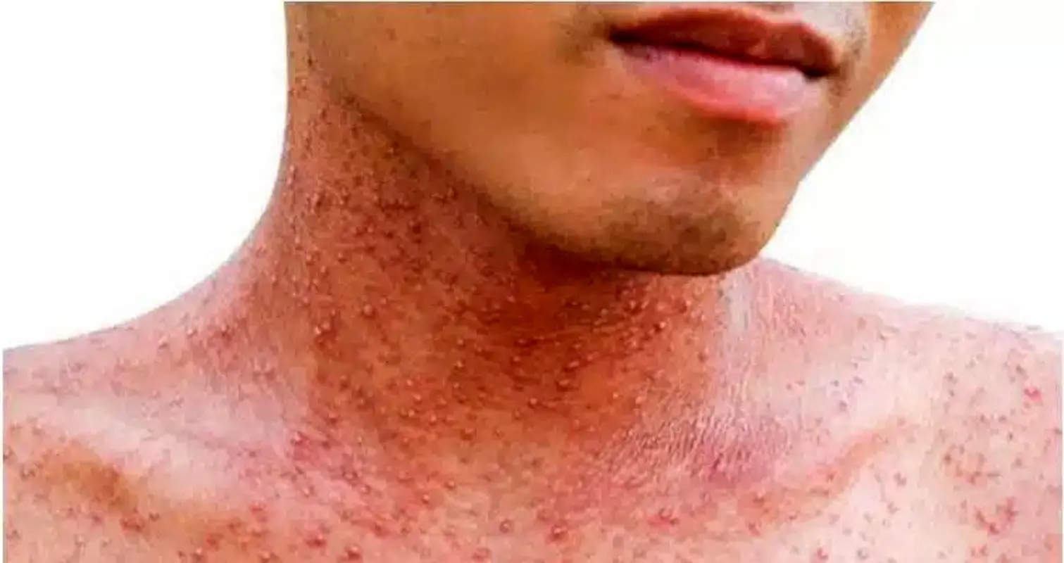 واکسن بزنید اگر در کودکی آبله‌مرغان نگرفته‌اید