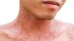 واکسن بزنید اگر در کودکی آبله‌مرغان نگرفته‌اید