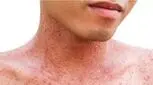 واکسن بزنید اگر در کودکی آبله‌مرغان نگرفته‌اید