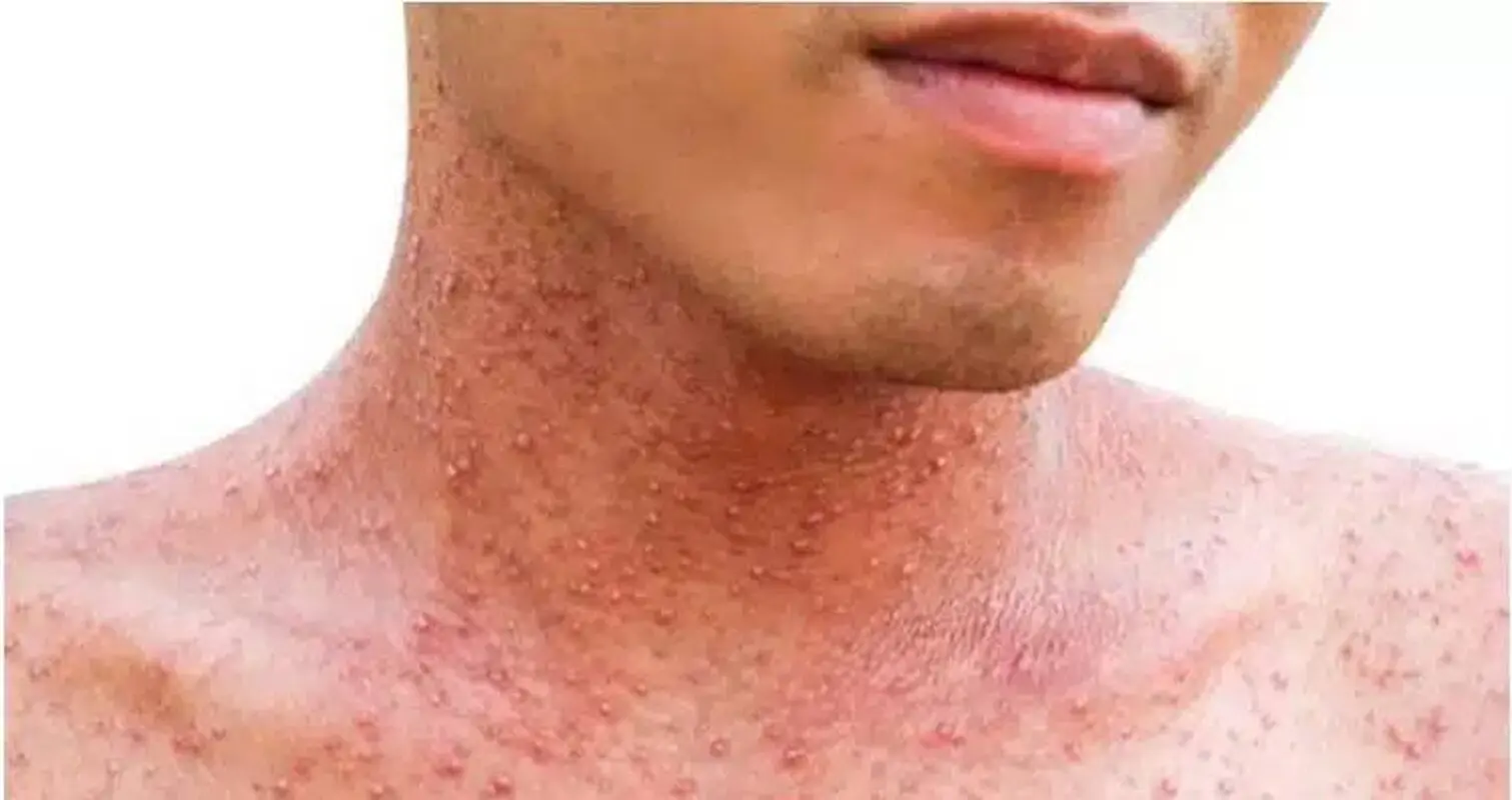 واکسن بزنید اگر در کودکی آبله‌مرغان نگرفته‌اید