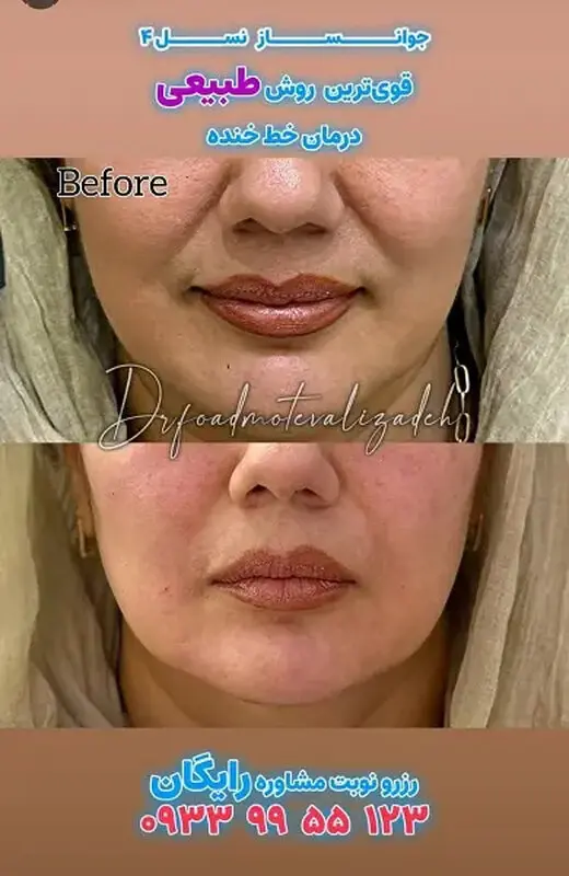 جوانساز هیبریدی نسل چهارم یا نخ مایع