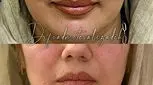 جوانساز هیبریدی نسل چهارم یا نخ مایع
