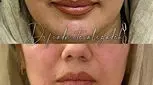 جوانساز هیبریدی نسل چهارم یا نخ مایع