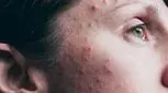  انواع مختلف آکنه (ویدئو)