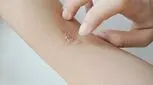 نحوه درمان اسکارهای هیدرادنیت چرکی