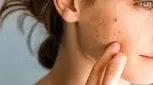 ۶ اشتباه رایج که جوش‌های صورتتان را بدتر می‌کند