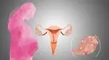 ناباروری تنبلی تخمدان، چاره چیست؟