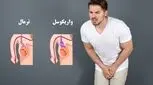 واریکوسل چیست و چه عوارضی برای کودکان و نوجوانان دارد؟