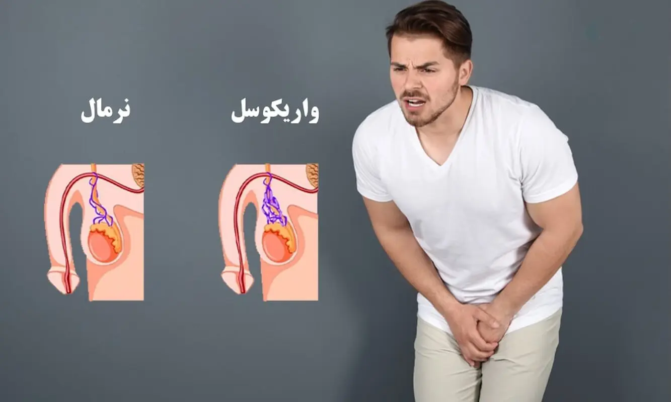واریکوسل چیست و چه عوارضی برای کودکان و نوجوانان دارد؟